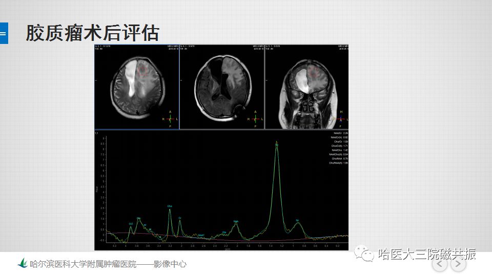 影像PPT - 【PPT】磁共振波谱（MRS）的那些事-40