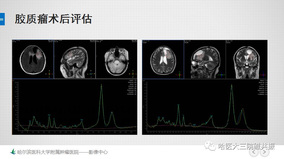 影像PPT - 【PPT】磁共振波谱（MRS）的那些事-42