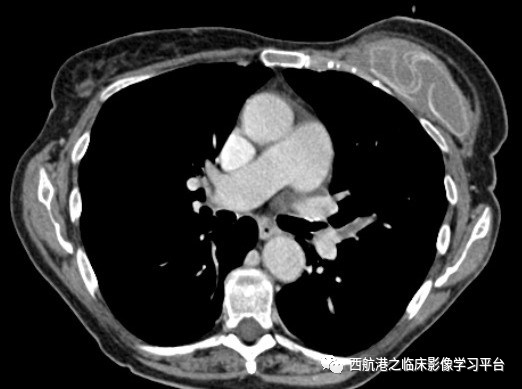 影像PPT - 【病例】真性红细胞增多症1例CT及MR影像-5 影像PPT - 【病例】真性红细胞增多症1例CT及MR影像-5