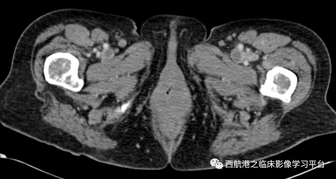 影像PPT - 【病例】真性红细胞增多症1例CT及MR影像-7 影像PPT - 【病例】真性红细胞增多症1例CT及MR影像-7