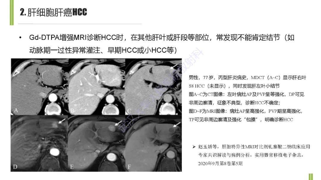 影像PPT - 【PPT】肝胆期肝局灶性异常信号影像诊断-11