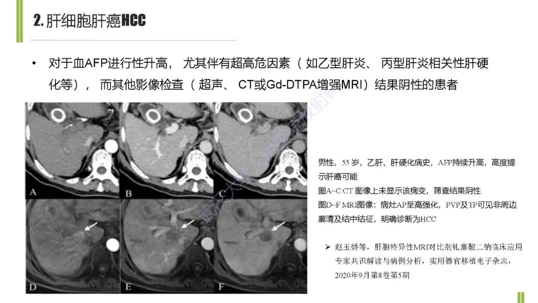 影像PPT - 【PPT】肝胆期肝局灶性异常信号影像诊断-9