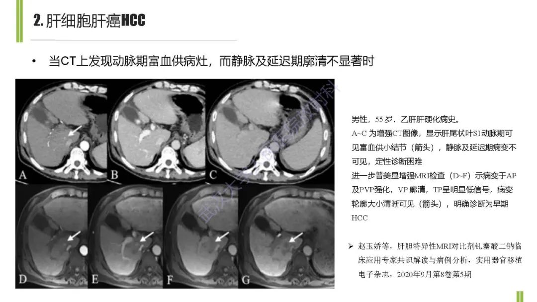 影像PPT - 【PPT】肝胆期肝局灶性异常信号影像诊断-8