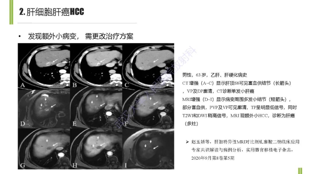 影像PPT - 【PPT】肝胆期肝局灶性异常信号影像诊断-10