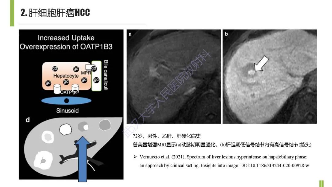影像PPT - 【PPT】肝胆期肝局灶性异常信号影像诊断-14
