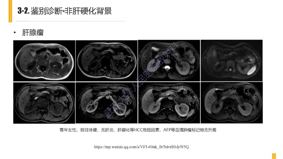 影像PPT - 【PPT】肝胆期肝局灶性异常信号影像诊断-18