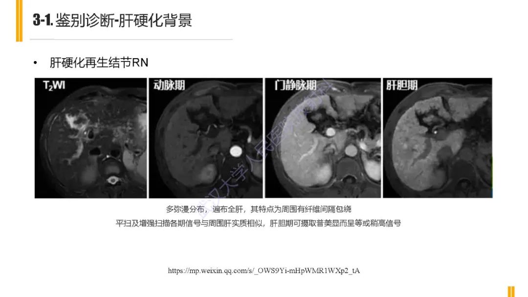 影像PPT - 【PPT】肝胆期肝局灶性异常信号影像诊断-16