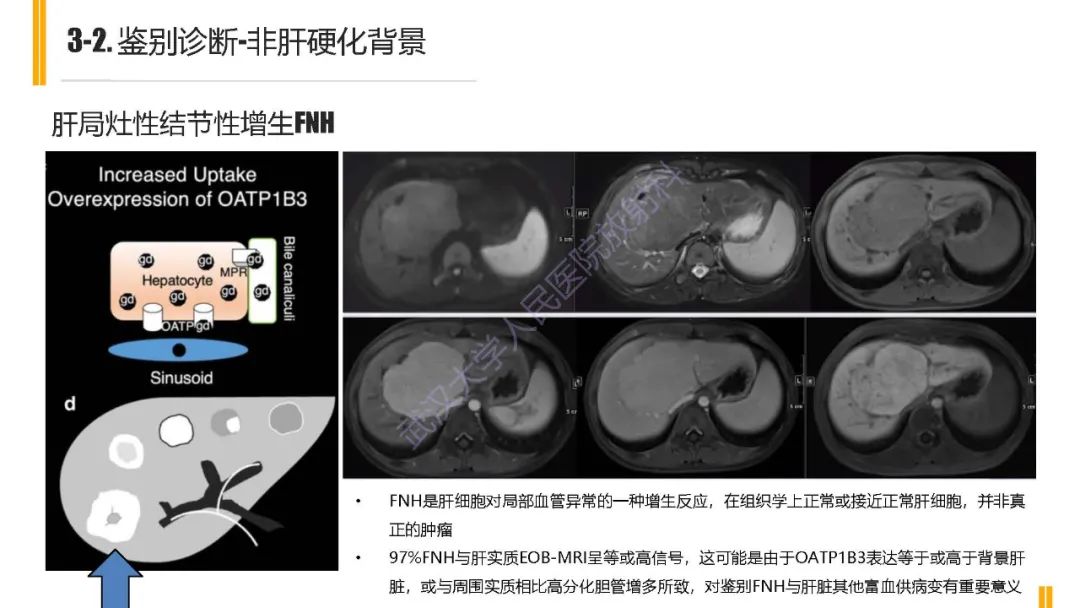 影像PPT - 【PPT】肝胆期肝局灶性异常信号影像诊断-19