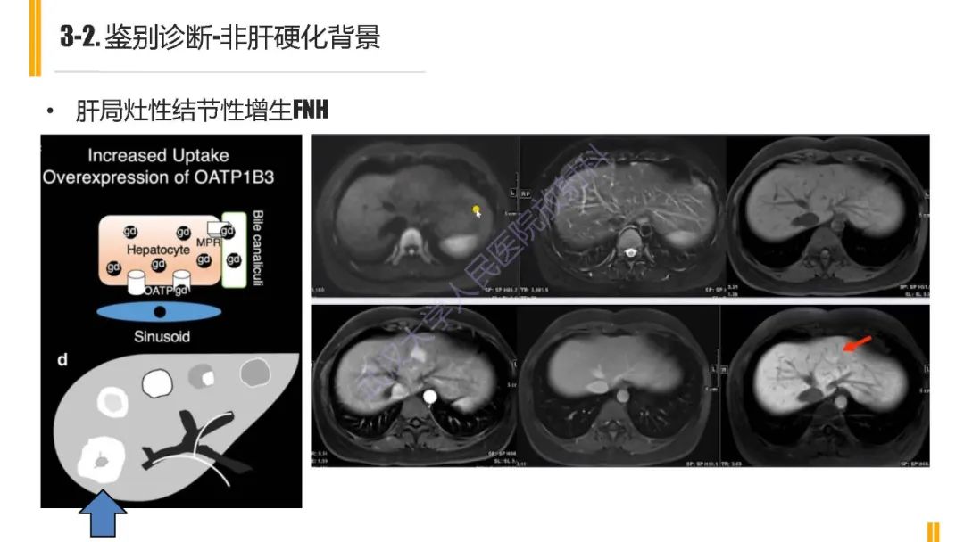 影像PPT - 【PPT】肝胆期肝局灶性异常信号影像诊断-20