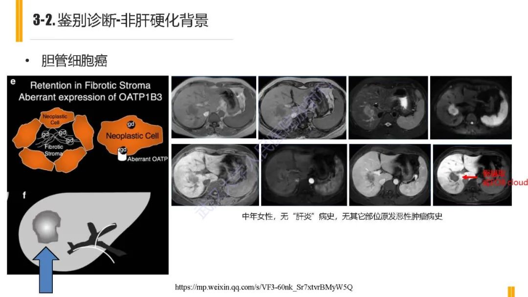 影像PPT - 【PPT】肝胆期肝局灶性异常信号影像诊断-21