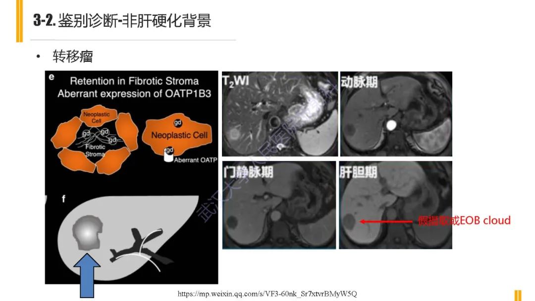影像PPT - 【PPT】肝胆期肝局灶性异常信号影像诊断-22