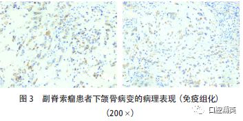影像PPT - 【病例】颌骨副脊索瘤1例CT影像-3 影像PPT - 【病例】颌骨副脊索瘤1例CT影像-3