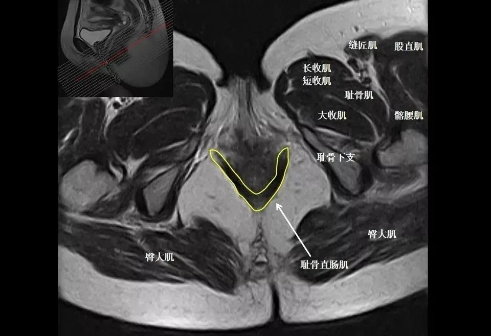 影像PPT - 8张图带你熟悉盆底MRI解剖-2