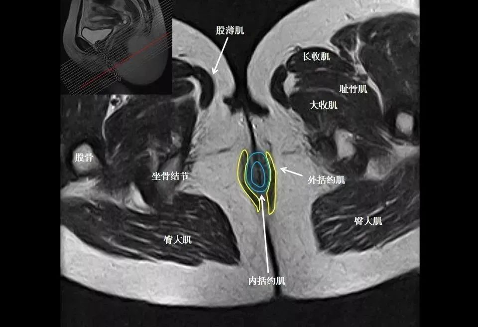 影像PPT - 8张图带你熟悉盆底MRI解剖-4