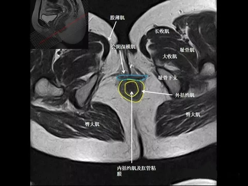 影像PPT - 8张图带你熟悉盆底MRI解剖-3