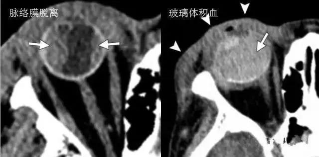 影像PPT - 6种眼球损伤疾病的影像学表现-6 影像PPT - 6种眼球损伤疾病的影像学表现-6