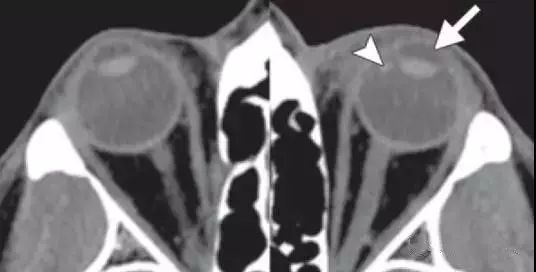 影像PPT - 6种眼球损伤疾病的影像学表现-10 影像PPT - 6种眼球损伤疾病的影像学表现-10
