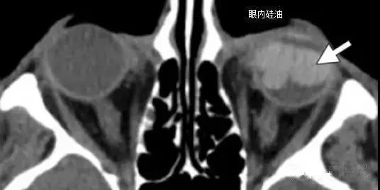 影像PPT - 6种眼球损伤疾病的影像学表现-15 影像PPT - 6种眼球损伤疾病的影像学表现-15