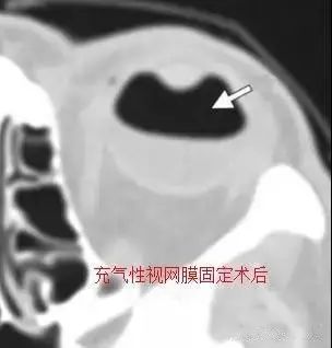 影像PPT - 6种眼球损伤疾病的影像学表现-16 影像PPT - 6种眼球损伤疾病的影像学表现-16