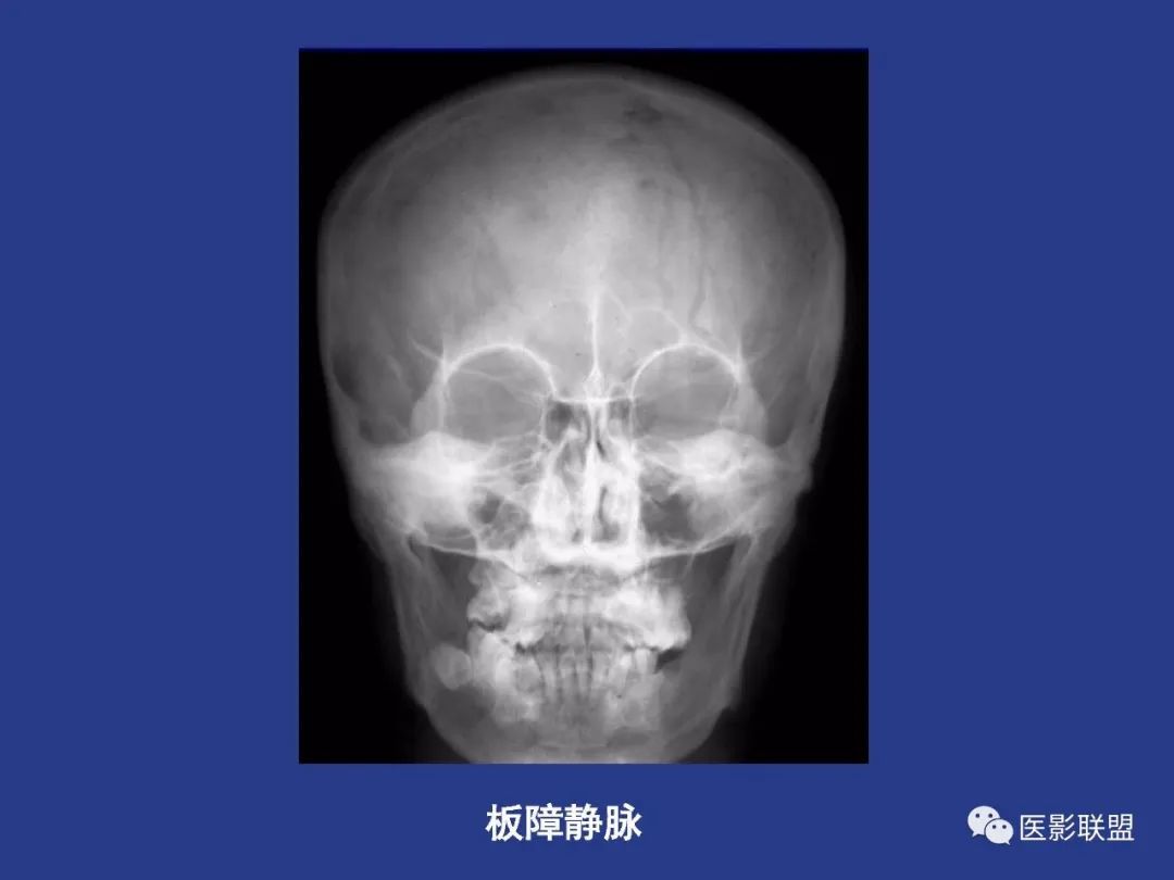 影像PPT - 【PPT】颅穹隆骨正常及常见变异的影像学表现-19