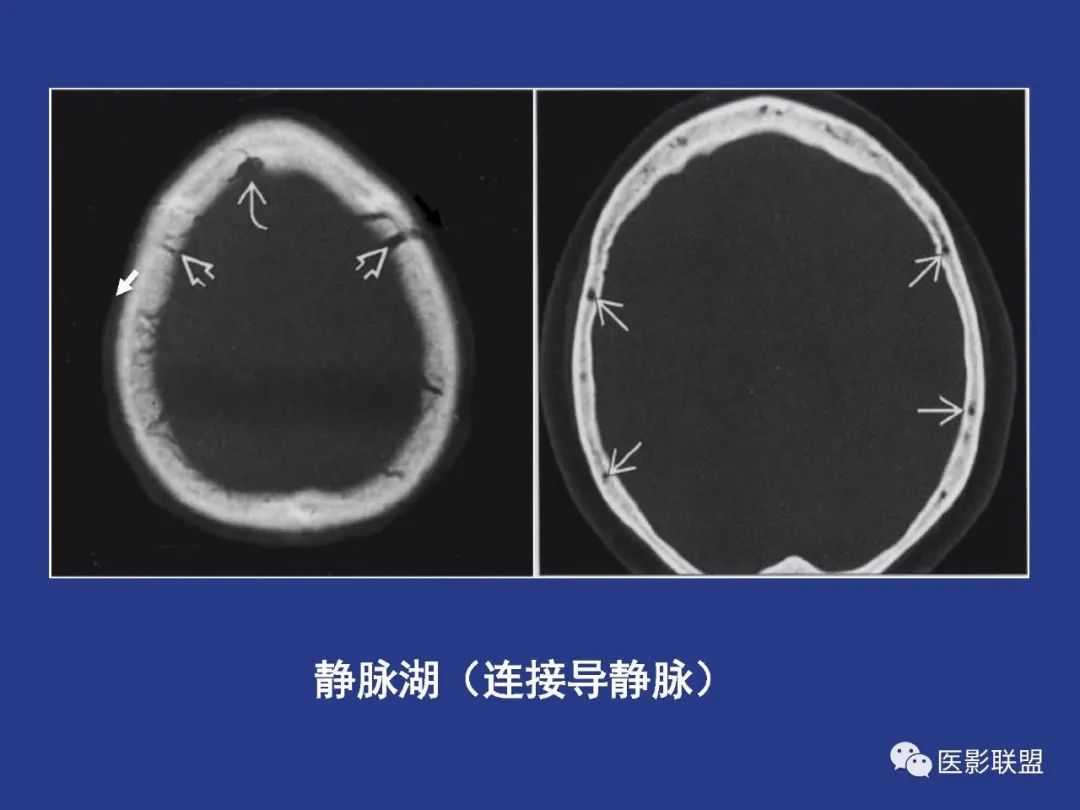 影像PPT - 【PPT】颅穹隆骨正常及常见变异的影像学表现-20