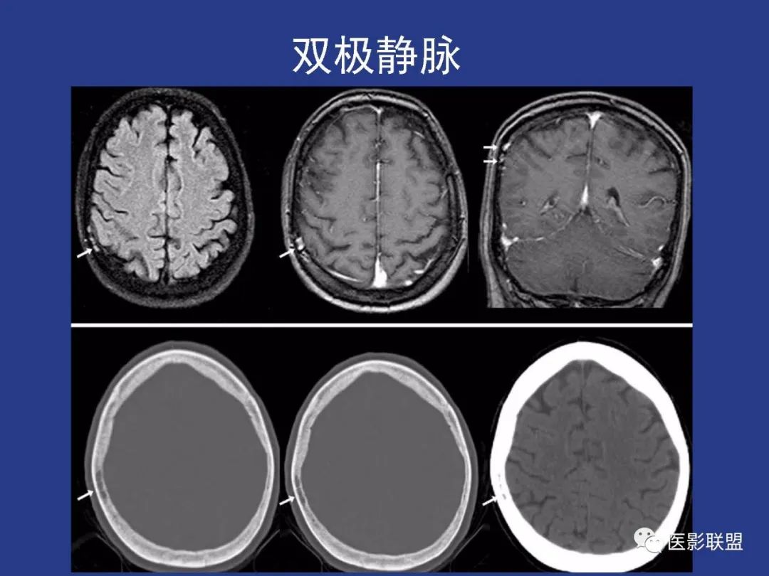 影像PPT - 【PPT】颅穹隆骨正常及常见变异的影像学表现-21