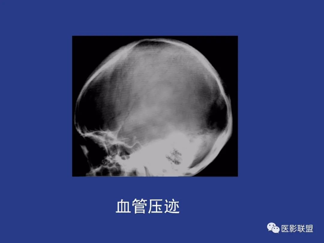 影像PPT - 【PPT】颅穹隆骨正常及常见变异的影像学表现-23