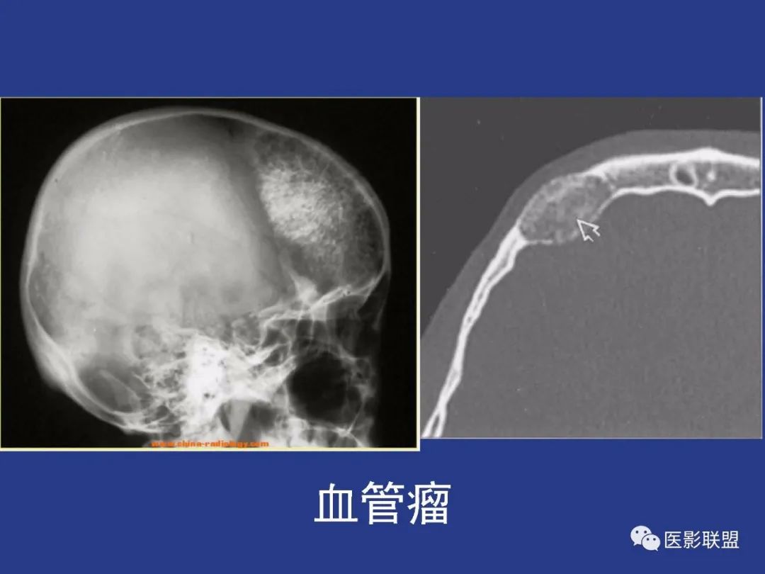 影像PPT - 【PPT】颅穹隆骨正常及常见变异的影像学表现-27