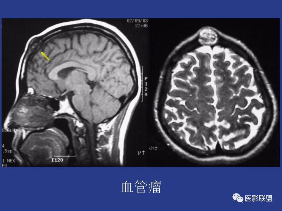 影像PPT - 【PPT】颅穹隆骨正常及常见变异的影像学表现-28