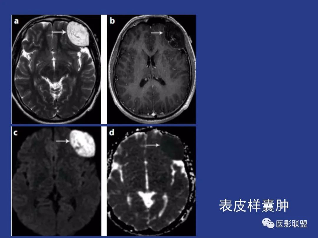 影像PPT - 【PPT】颅穹隆骨正常及常见变异的影像学表现-35