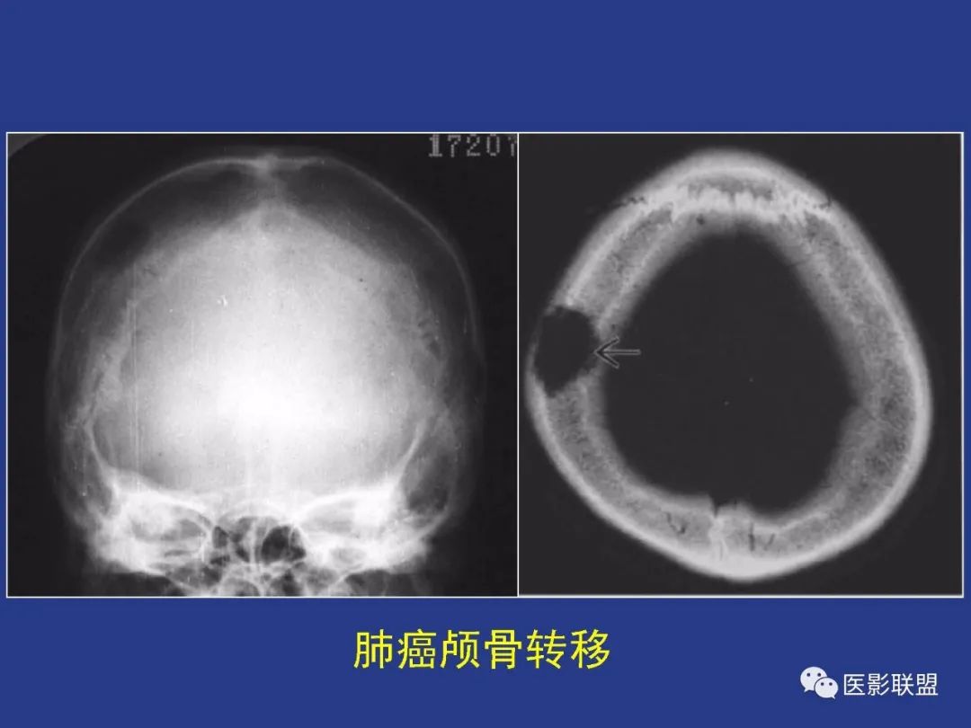 影像PPT - 【PPT】颅穹隆骨正常及常见变异的影像学表现-37