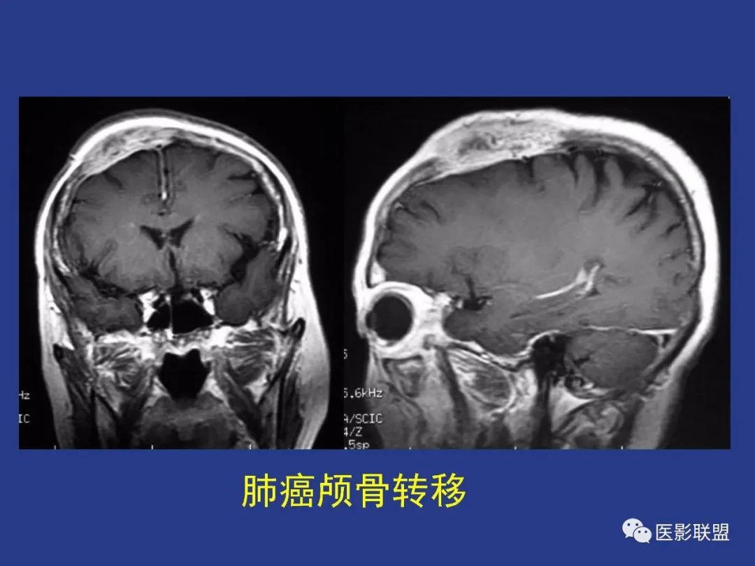 影像PPT - 【PPT】颅穹隆骨正常及常见变异的影像学表现-38
