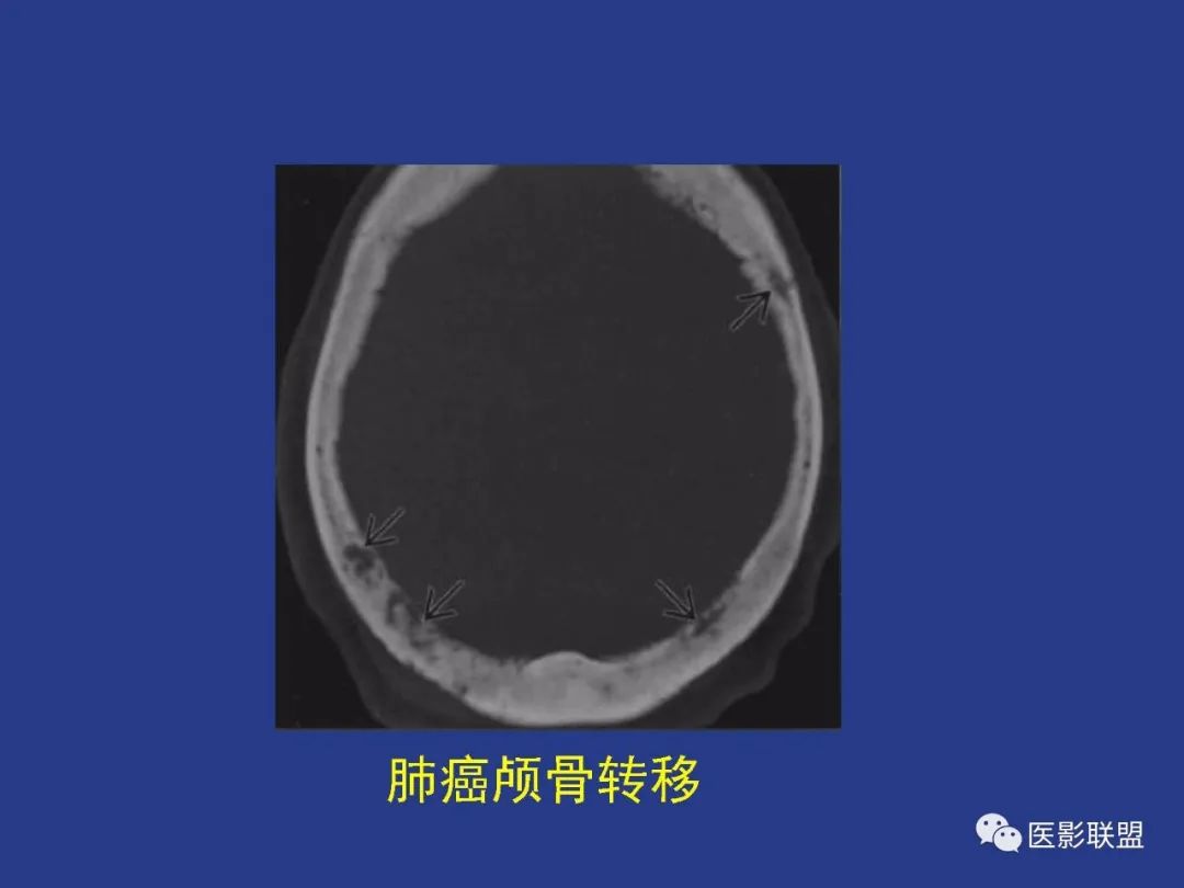 影像PPT - 【PPT】颅穹隆骨正常及常见变异的影像学表现-39