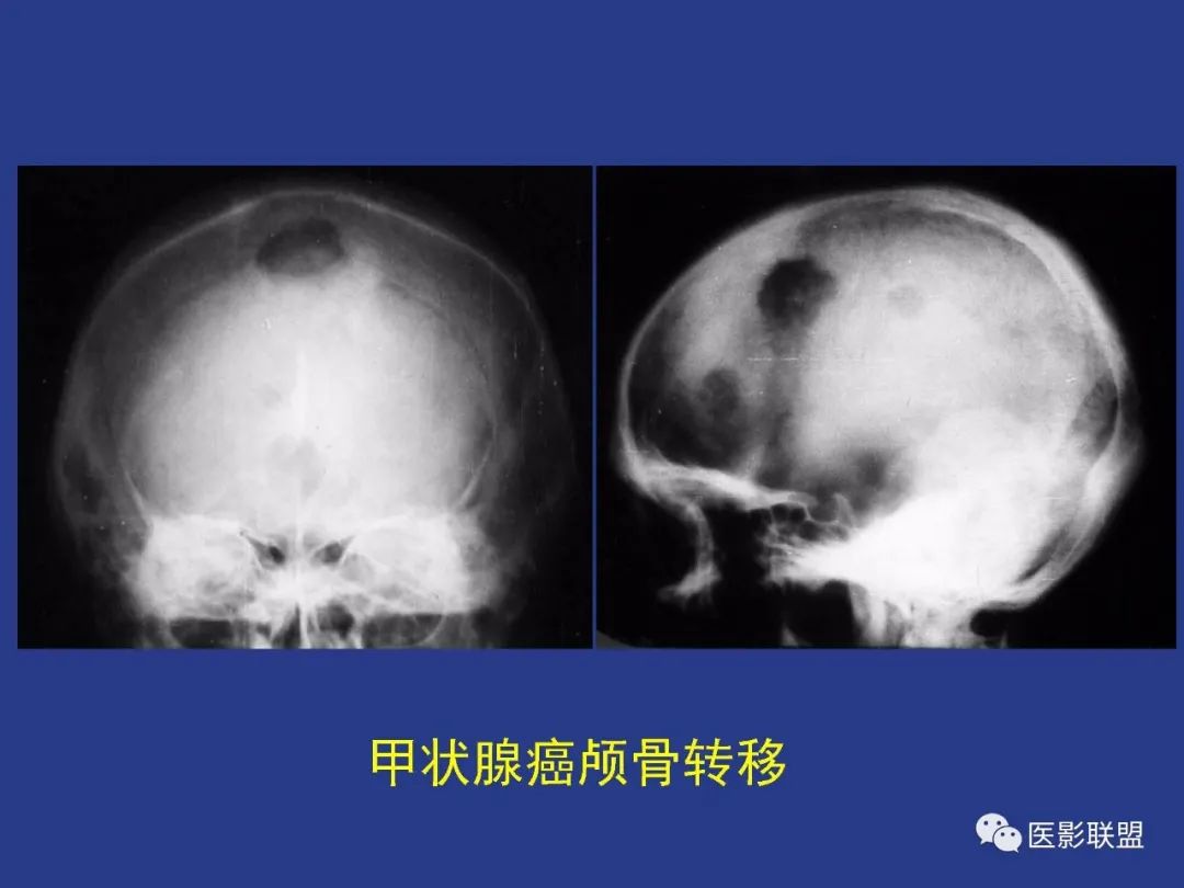 影像PPT - 【PPT】颅穹隆骨正常及常见变异的影像学表现-40