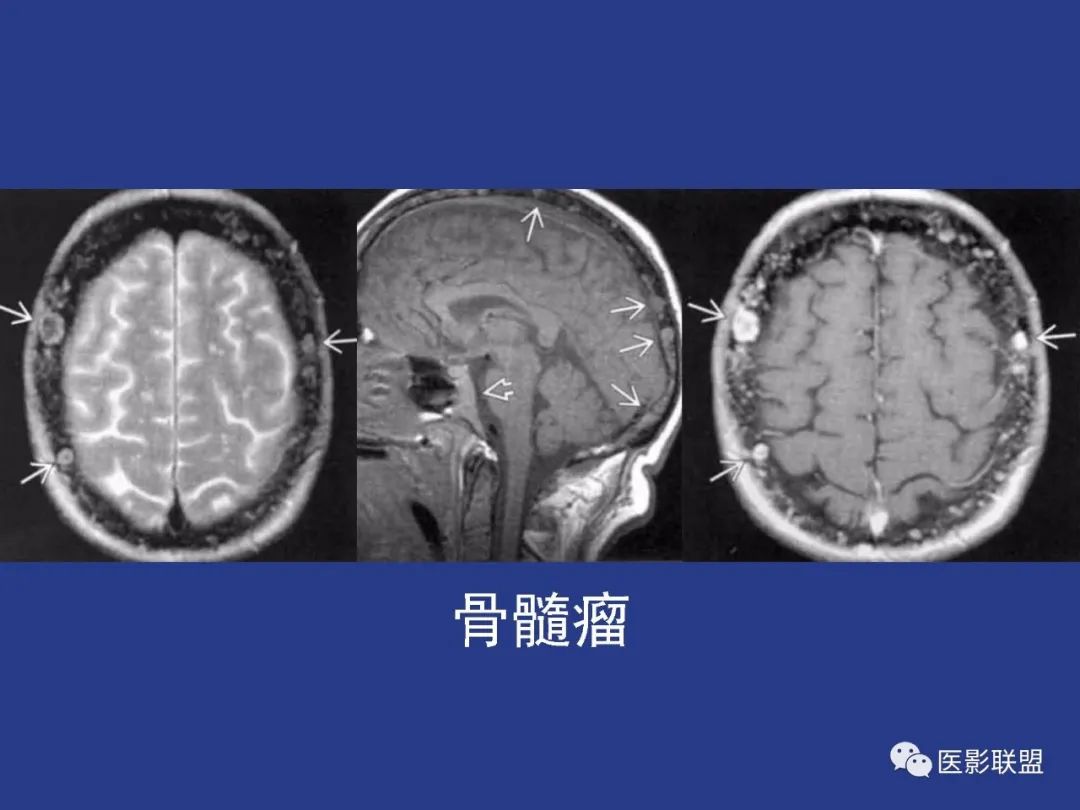 影像PPT - 【PPT】颅穹隆骨正常及常见变异的影像学表现-44
