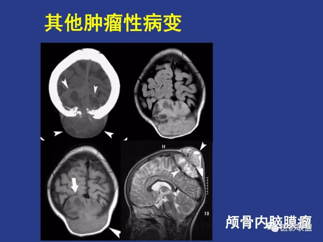 影像PPT - 【PPT】颅穹隆骨正常及常见变异的影像学表现-45