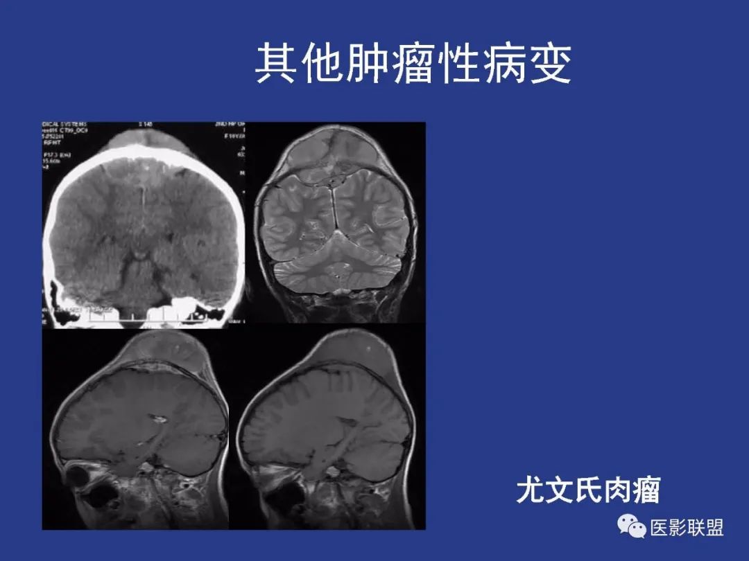 影像PPT - 【PPT】颅穹隆骨正常及常见变异的影像学表现-46