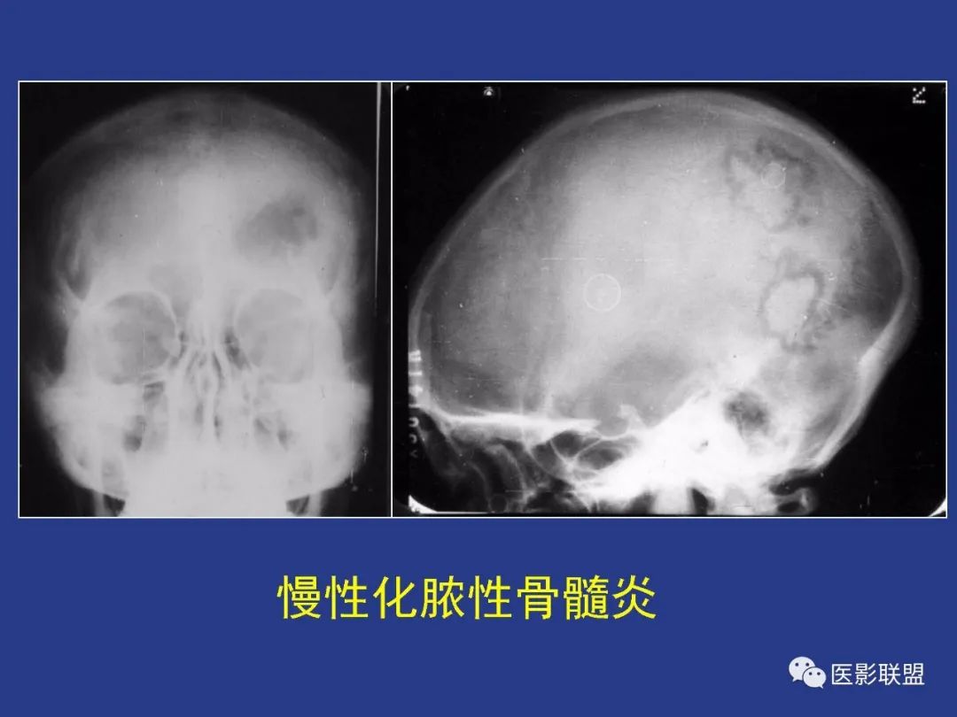 影像PPT - 【PPT】颅穹隆骨正常及常见变异的影像学表现-48