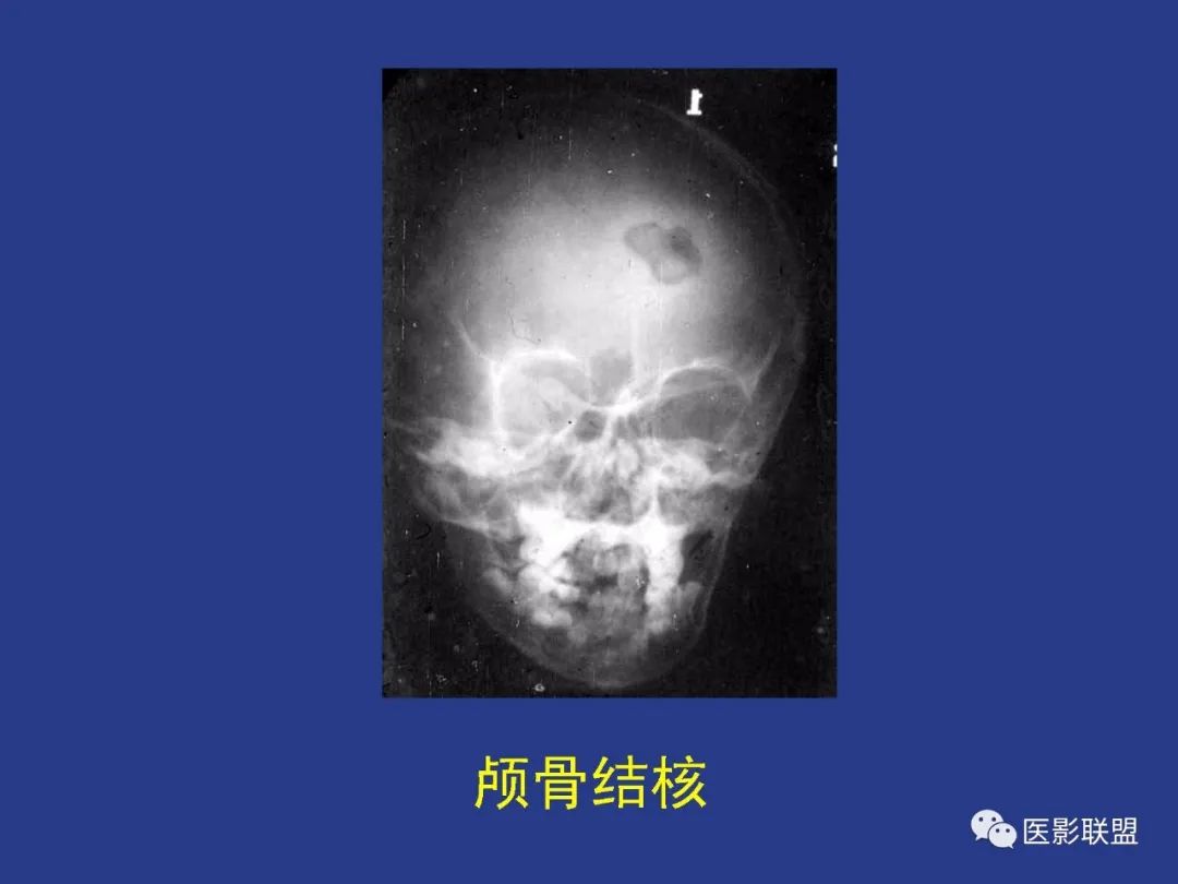 影像PPT - 【PPT】颅穹隆骨正常及常见变异的影像学表现-52