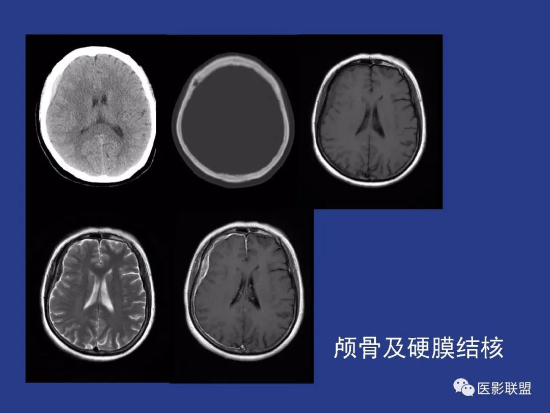 影像PPT - 【PPT】颅穹隆骨正常及常见变异的影像学表现-53