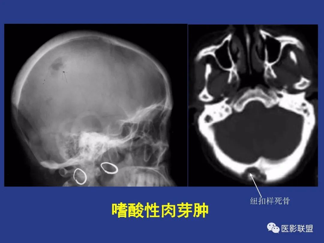 影像PPT - 【PPT】颅穹隆骨正常及常见变异的影像学表现-55