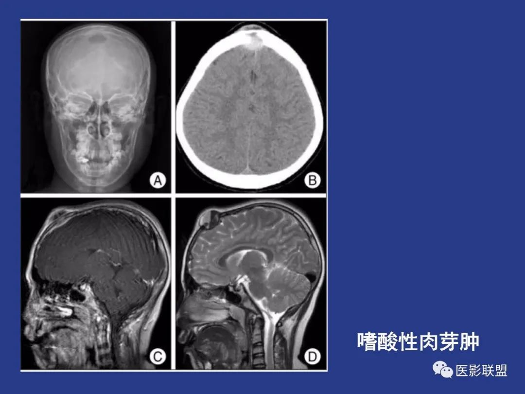 影像PPT - 【PPT】颅穹隆骨正常及常见变异的影像学表现-56