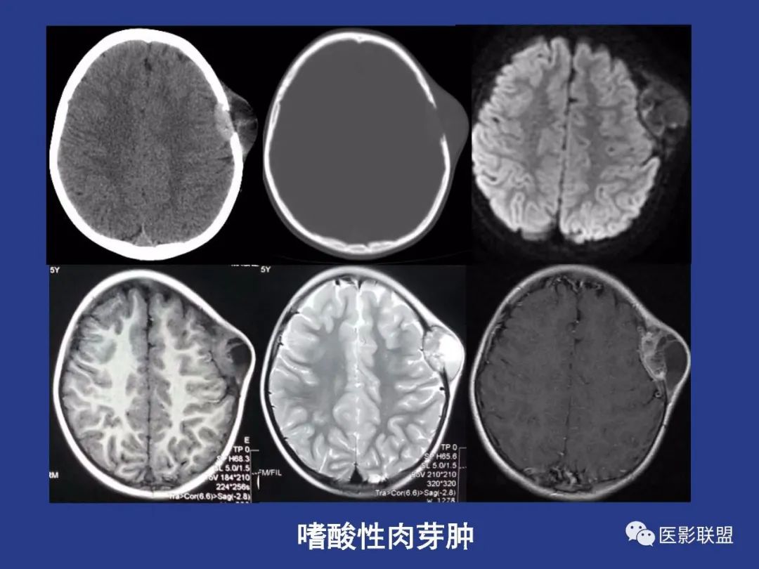 影像PPT - 【PPT】颅穹隆骨正常及常见变异的影像学表现-57