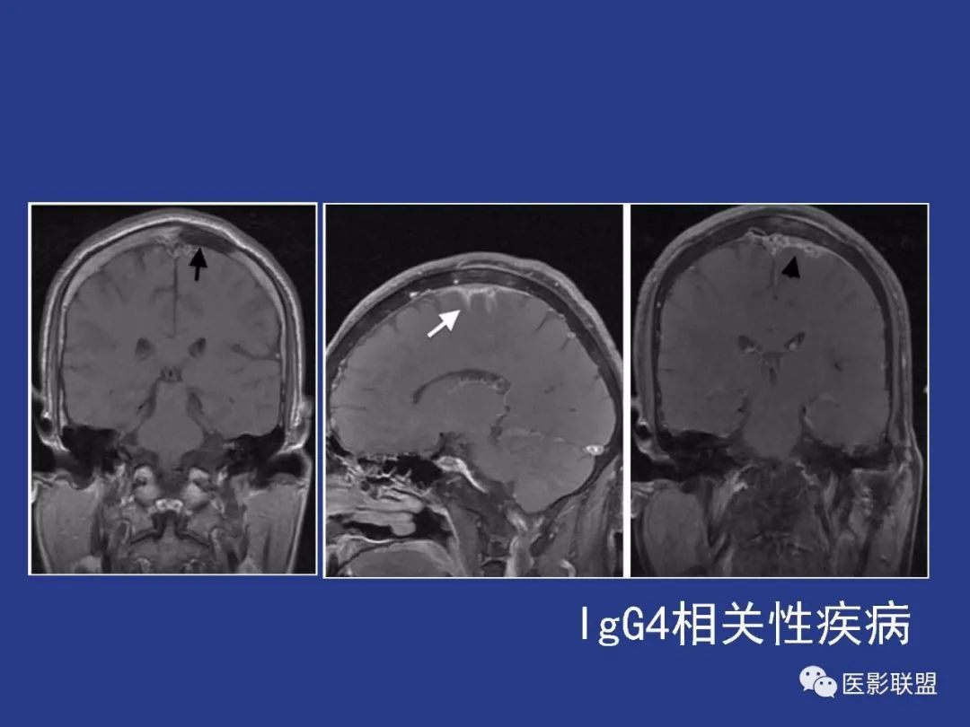 影像PPT - 【PPT】颅穹隆骨正常及常见变异的影像学表现-61
