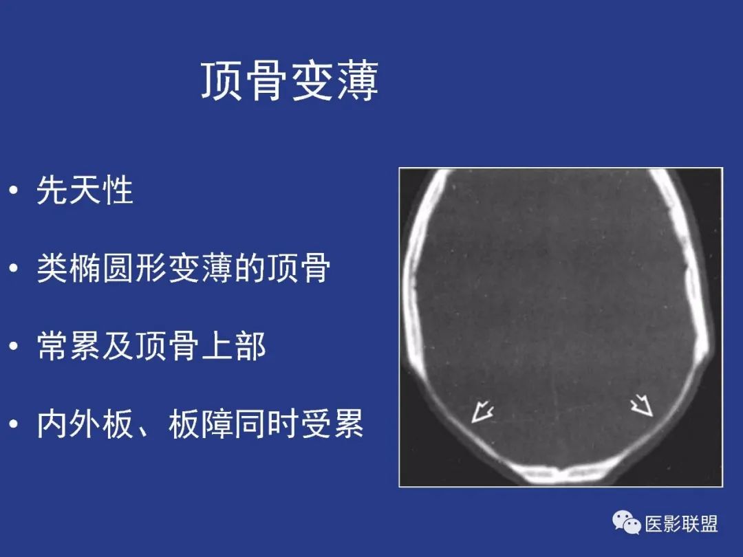 影像PPT - 【PPT】颅穹隆骨正常及常见变异的影像学表现-65