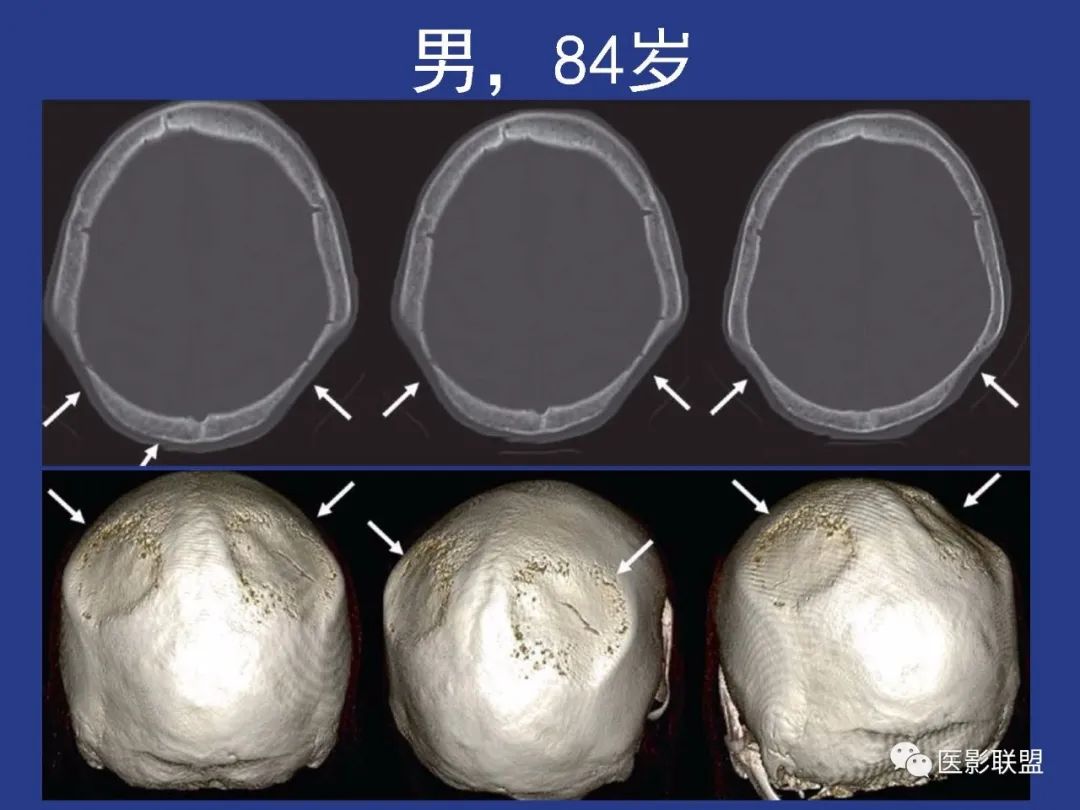 影像PPT - 【PPT】颅穹隆骨正常及常见变异的影像学表现-68