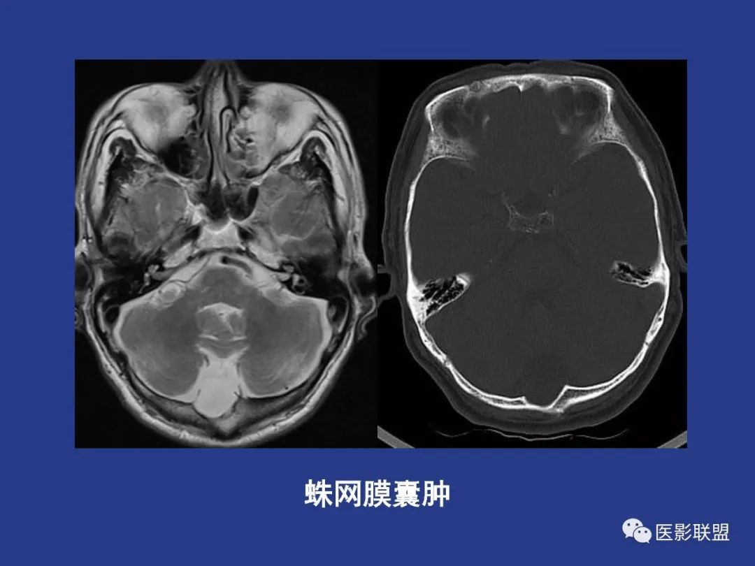 影像PPT - 【PPT】颅穹隆骨正常及常见变异的影像学表现-70
