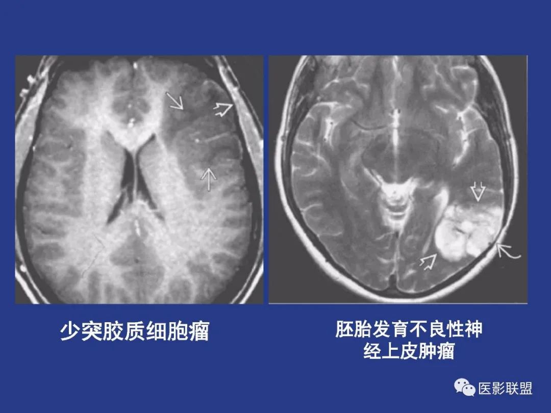 影像PPT - 【PPT】颅穹隆骨正常及常见变异的影像学表现-71