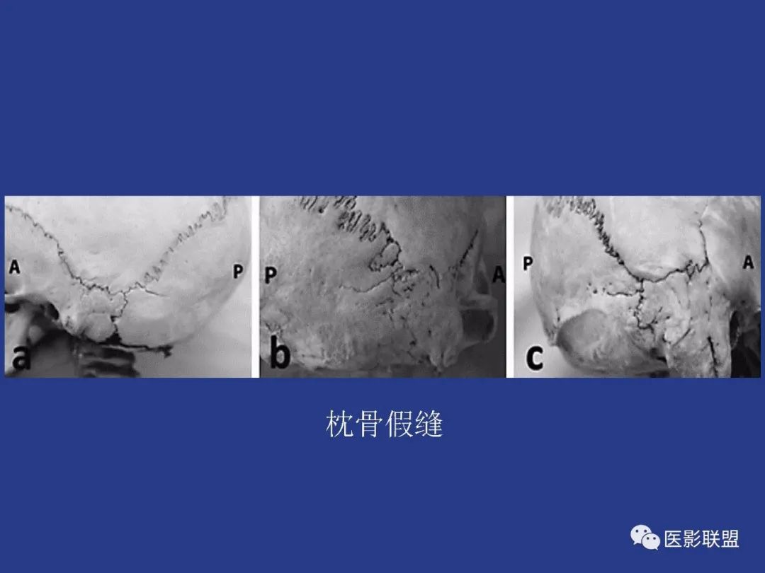 影像PPT - 【PPT】颅穹隆骨正常及常见变异的影像学表现-73