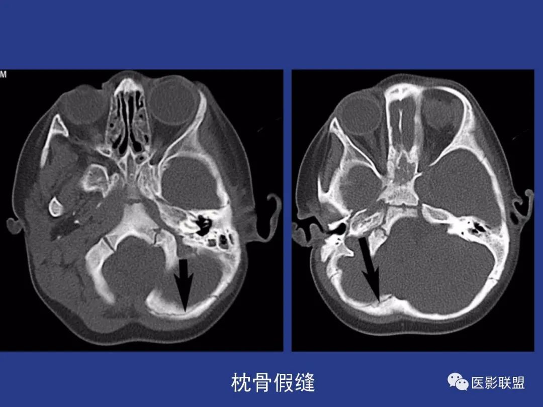 影像PPT - 【PPT】颅穹隆骨正常及常见变异的影像学表现-74
